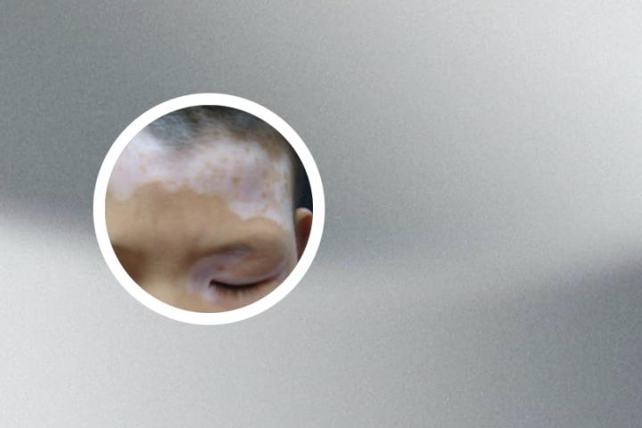 白癜风者可以吃西瓜吗