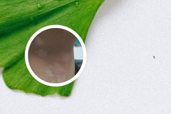 儿童白癜风特点文章