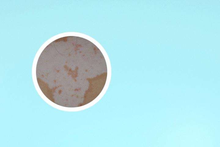 眼睛上白癜风