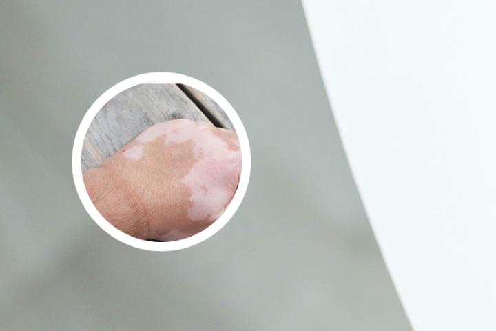 手上白癜风用什么药治疗