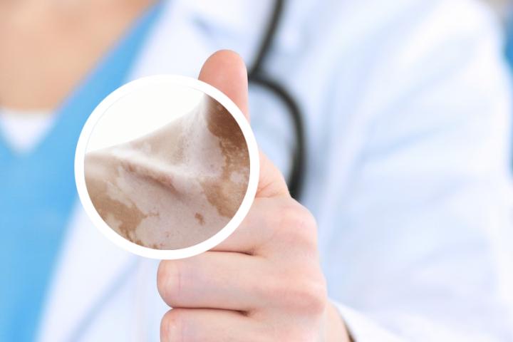 白癜风为啥让打胸腺五肽