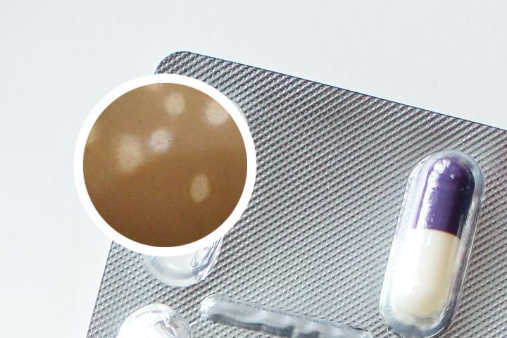 白癜风治疗有新成果吗