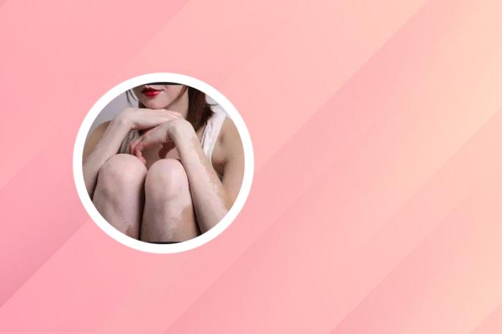 点阵激光后白癜风怎么办