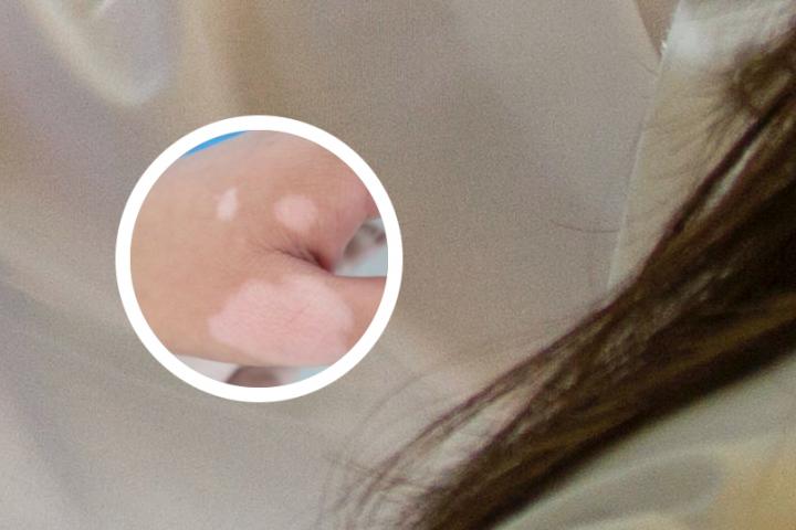 血糖低对白癜风有影响吗