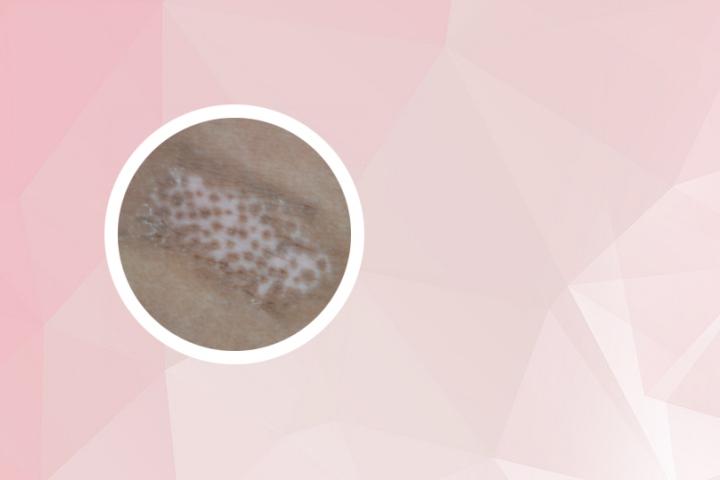 为什么我总是得白癜风
