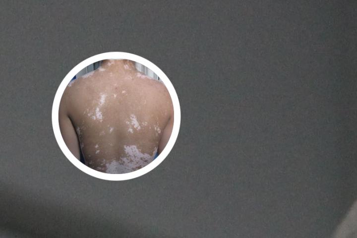 我脸上最近出现了白色的斑块，这是白癜风的初期症状吗
