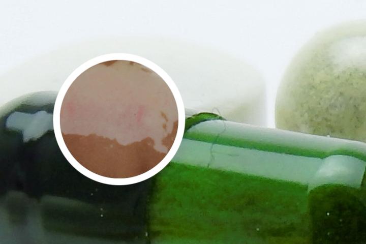 白癜风光疗后很红