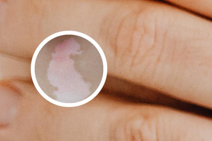 南京哪家白癜风治疗医院好