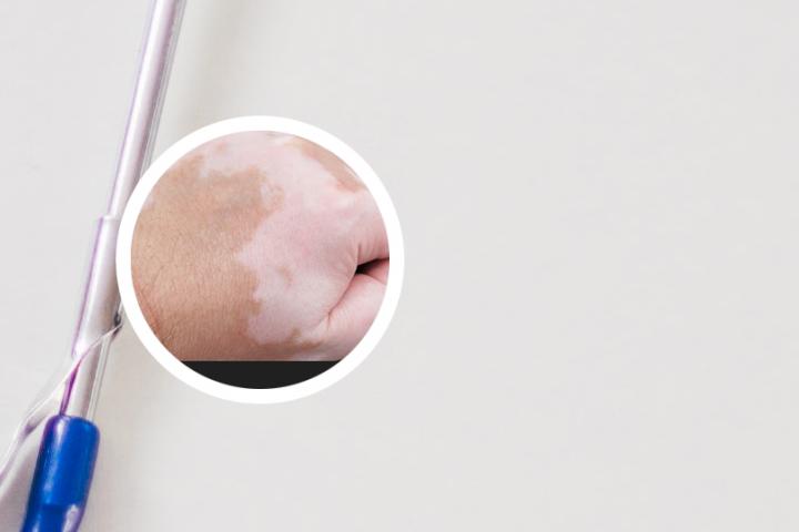 白癜风韦祖泉主任治疗方法