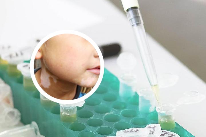 白癜风服药期间需要戒口吗