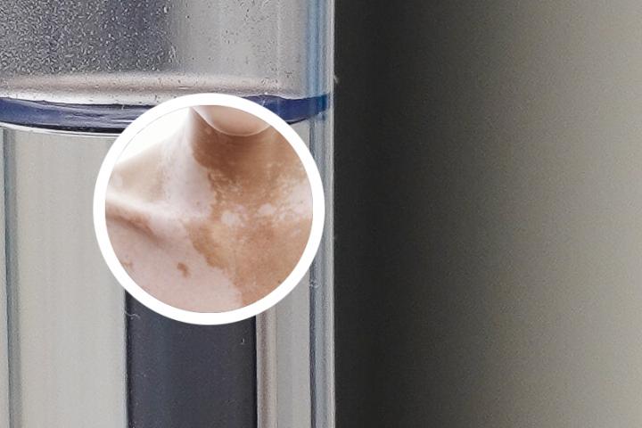 311灯可以照射白癜风吗