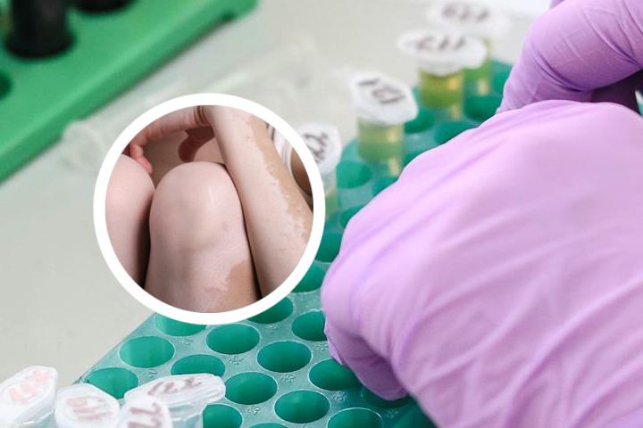 怎么分辨白癜风和汗斑