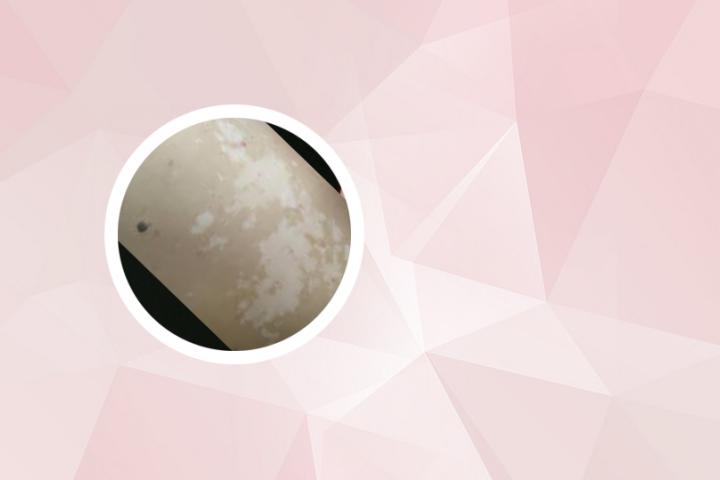 奇亚籽会导致白癜风吗