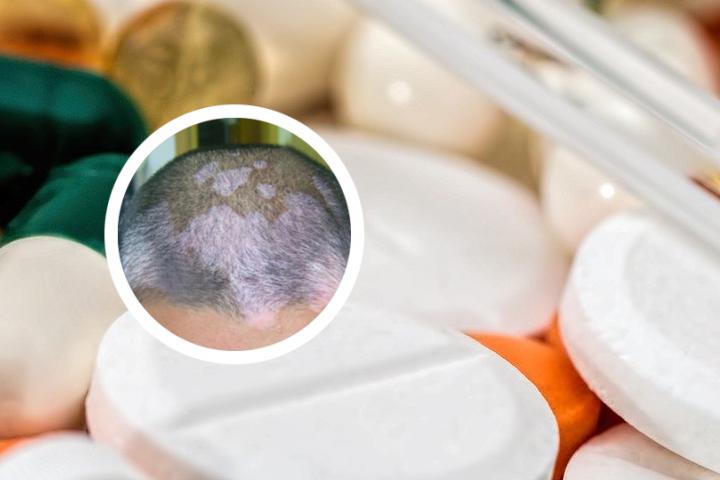 白癜风为何没有特效药 白癜风为何没有特效药