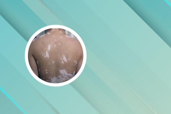 合肥能看白癜风吗