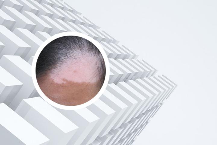 吉林白癜风有什么症状