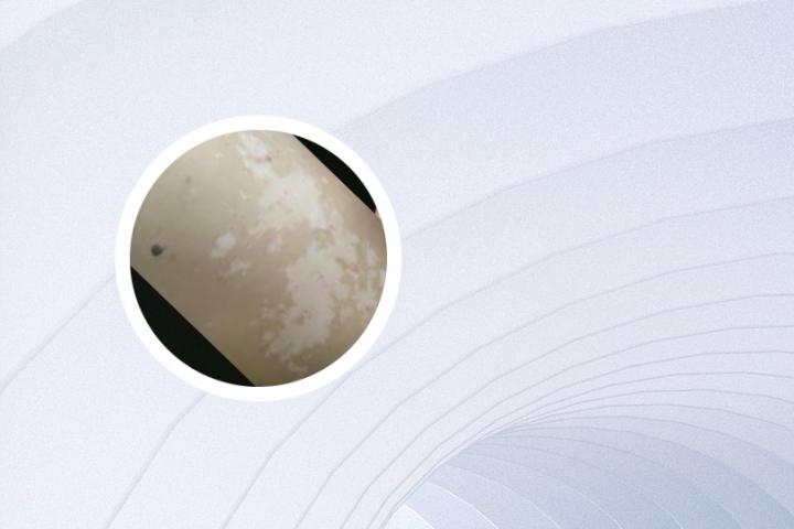白癜风是什么原因产生的