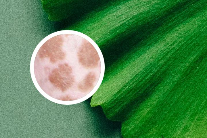 白癜风为啥是黑五类 白癜风为啥是世界难题治不好