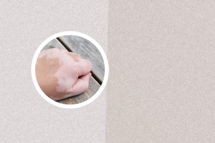 白癜风维生素多少钱 白癜风维生素c含量范围