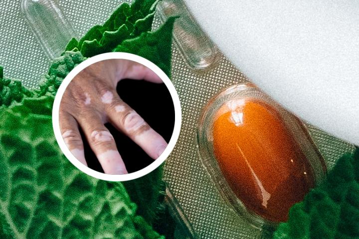 白癜风头皮变白药膏