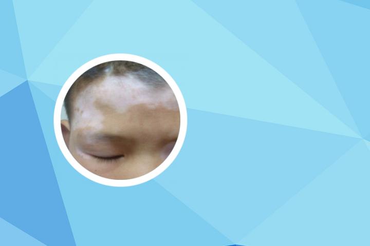 治疗白癜风的激光灯