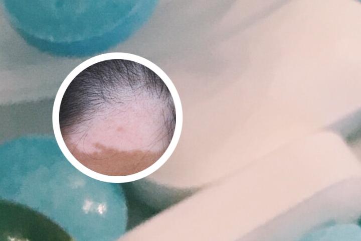 白癜风父亲没当回事