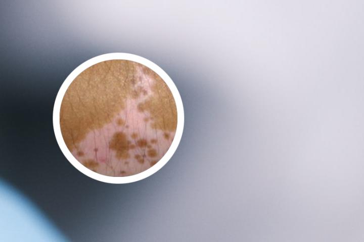 江苏专治点滴型白癜风