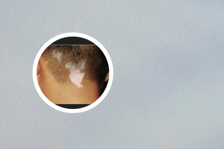 白癜风微量元素缺乏能治好吗