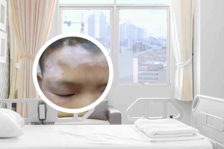 中医自查白癜风