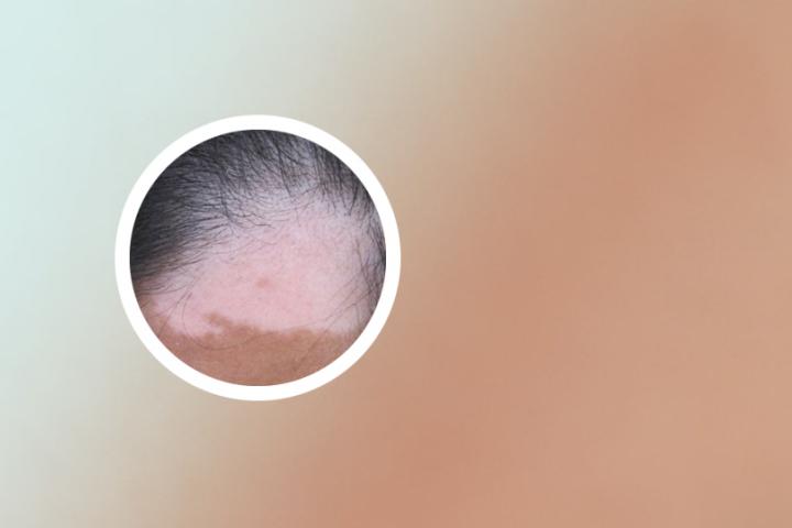 白癜风会引起皮肤白纹吗