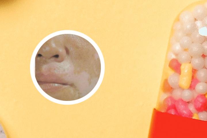 白癜风为啥少吃维c类水果