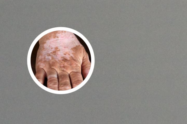 南京白癜风医院蓓肤康