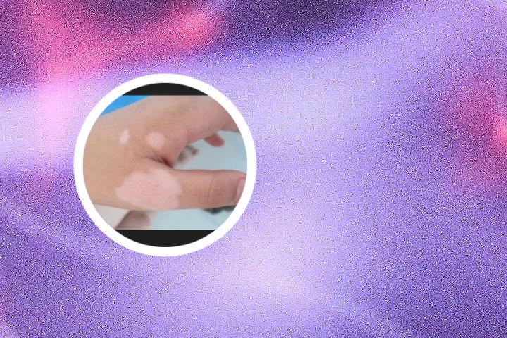 冬天白癜风会变稳吗