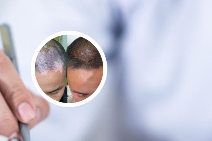 白癜风有好的治疗方法嘛