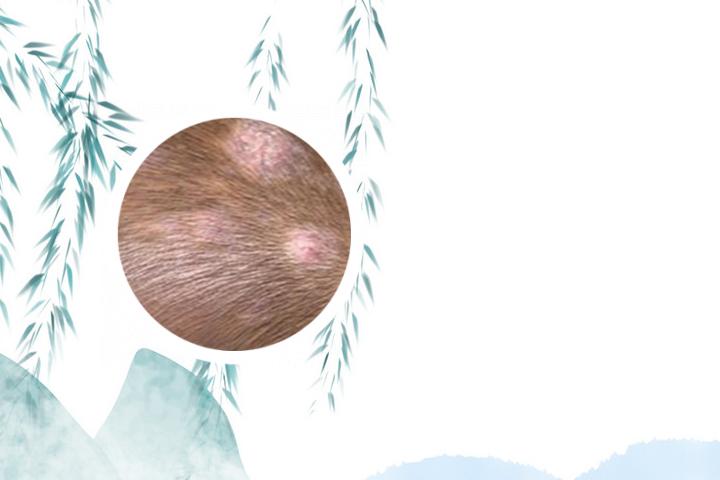 白癜风跟脾的关系