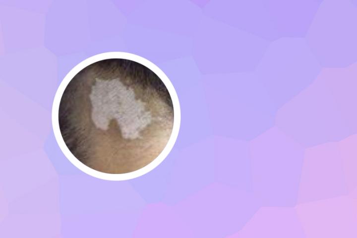白癜风吃西兰花好么