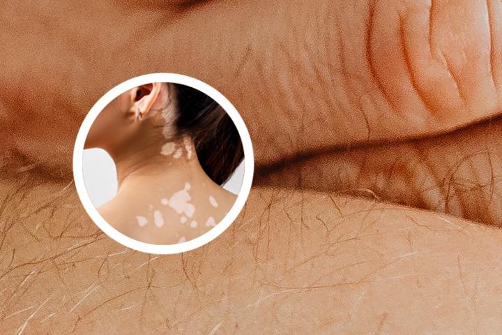 少儿白癜风心理学