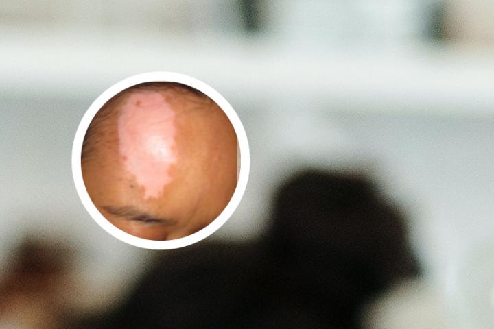 光疗治白癜风的好处