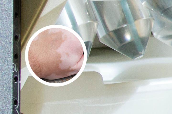 白癜风照光后怎样