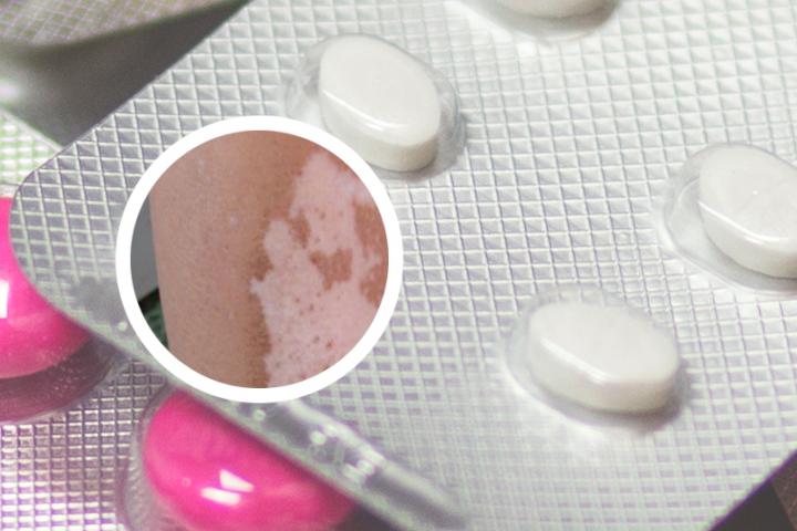 白癜风患者可以吃沙拉吗