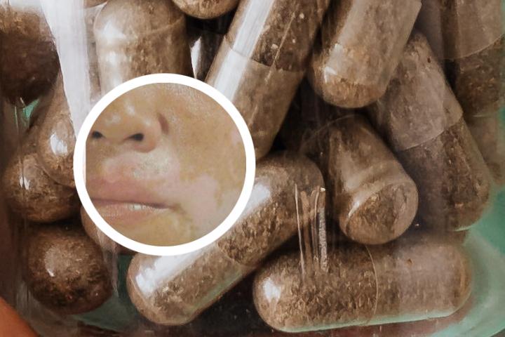 汕头白癜风治疗