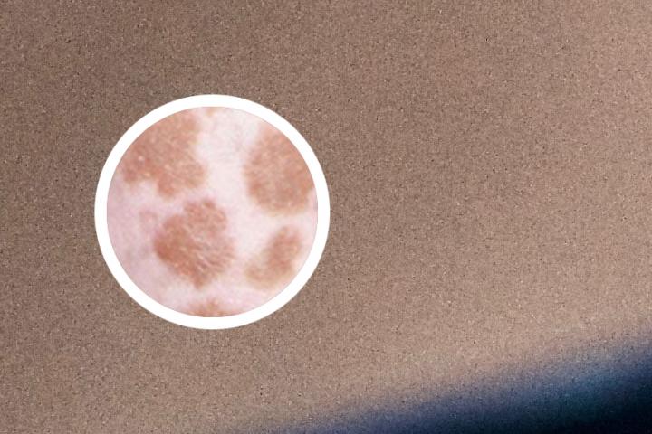 白癜风可以休学吗