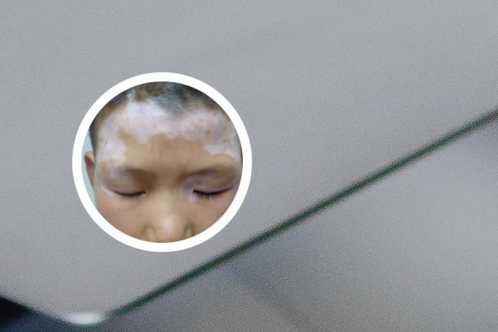 经常运动可以治疗白癜风吗