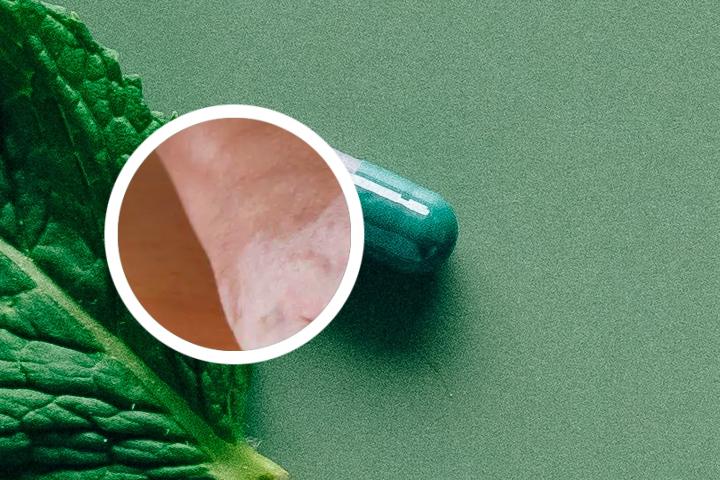 硅霜治白癜风吗