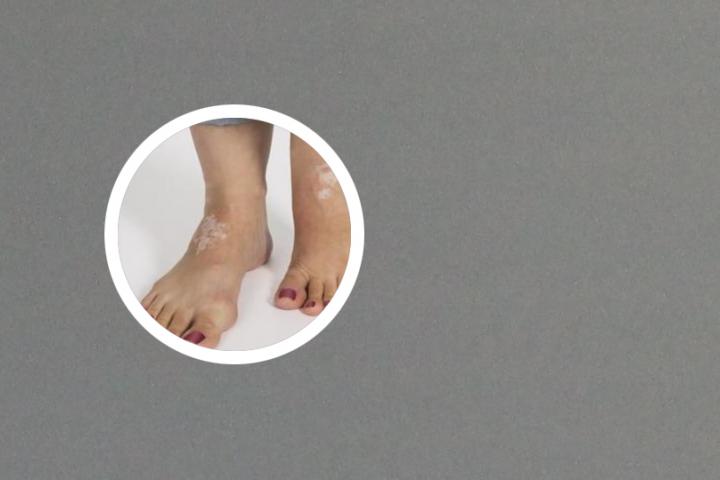 白癜风患者可以多吃桔子吗