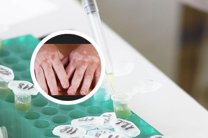 白癜风为啥不能吃香葱 白癜风为啥不能吃维生素c的水果