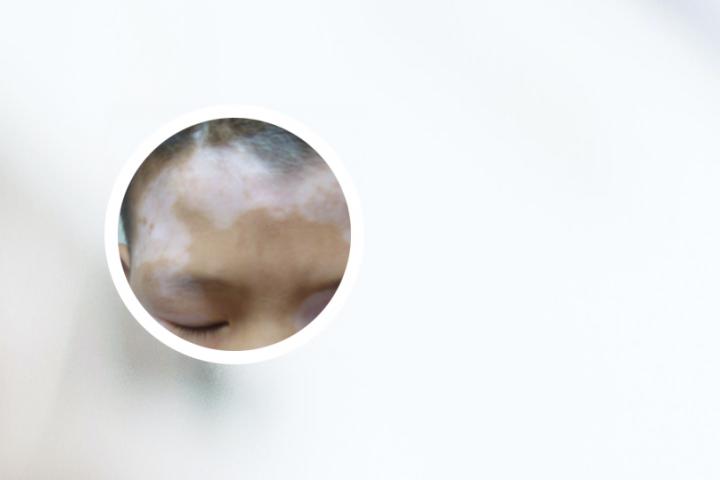 白癜风需要打几针激素针