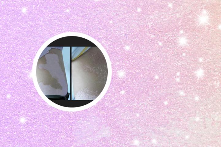 高中得了白癜风该如何治疗