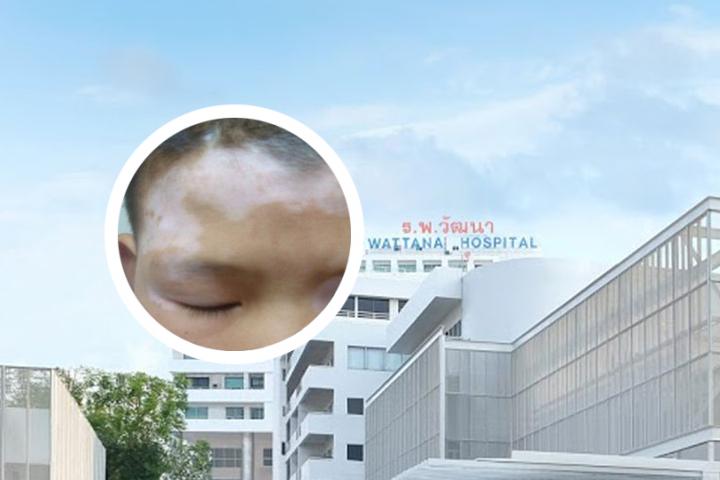 白癜风扩散期还能稳定吗
