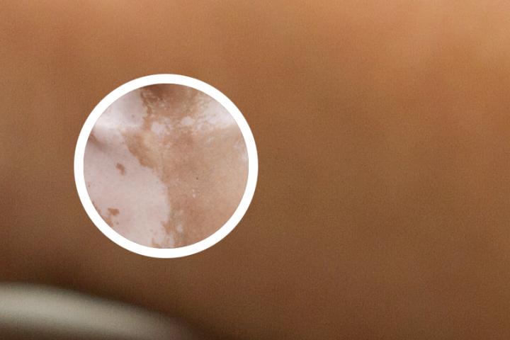 临夏治疗白癜风专科医院